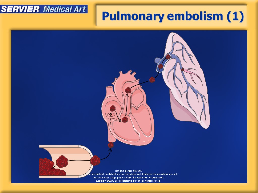 Pulmonary embolism (1)